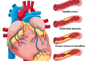 heart failure management in korba